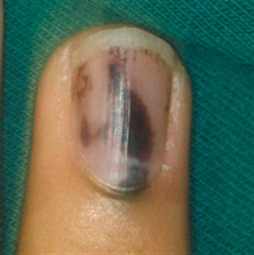 2.2 Longo has a Longditudinal Nail Strip