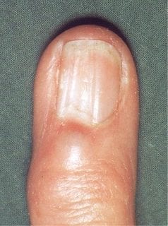 2.3 Bob has Longitudinal Nail Grooves