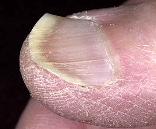 1.9 Dish has spoon shaped nails