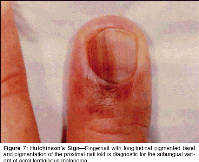 1.5 Bill has Brown Nails