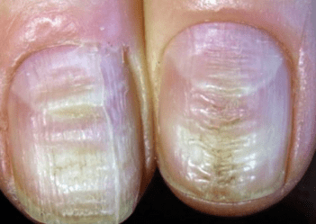 2.1 Rick has Nail horizontal grooves