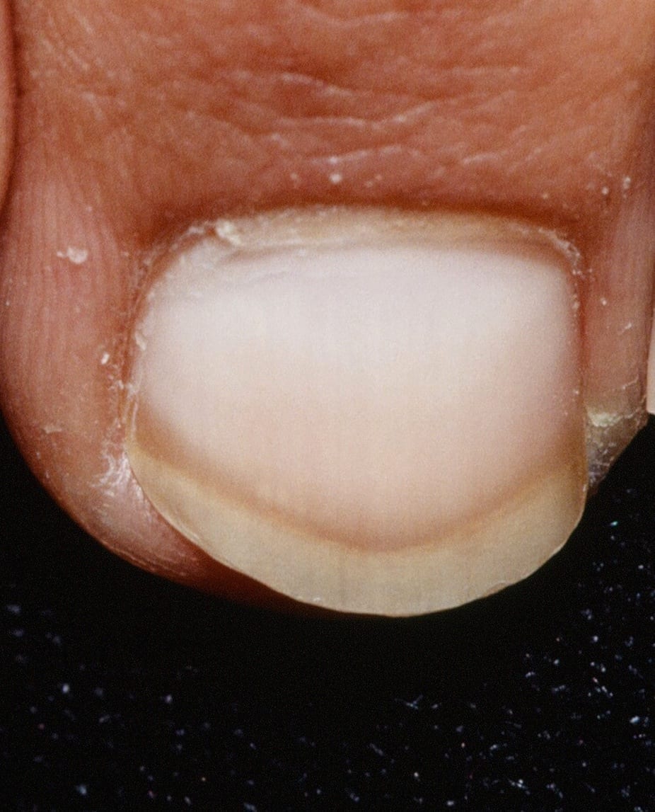 1.7 Donald has White Nails