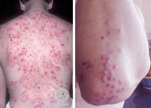 Dermatitis Herpetiformis